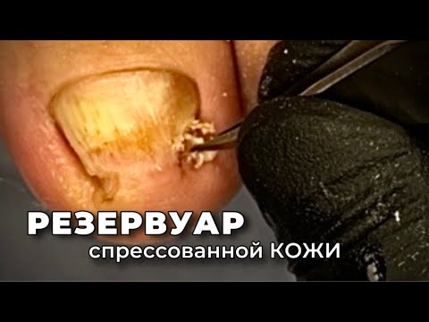 Видео: Пучение ногтевого ложа от давления кожного пресса