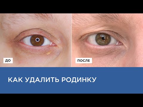 Видео: УДАЛЕНИЕ РОДИНОК