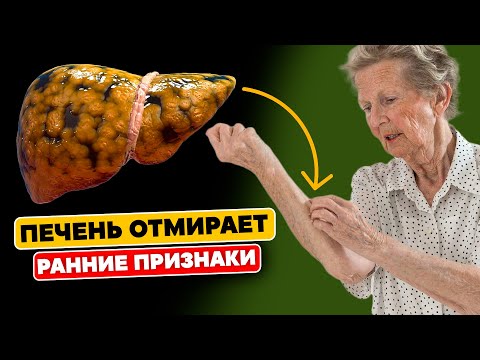 Видео: Вашей Печени Грозит Опасность: 6 ранних Признаков того, что ваша ПЕЧЕНЬ ОТМИРАЕТ