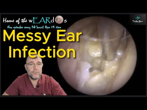 Видео: Инфекция уха 215 #ухо #ушнаясера #удалениеушнойсеры #чисткаушей #асмр #асмрушнаясера #инфекция