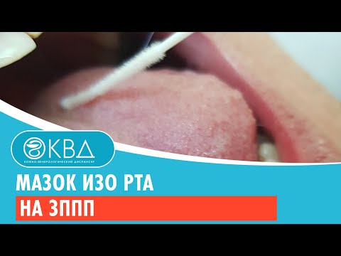 Видео: Мазок изо рта на ЗППП. Клинический случай №100