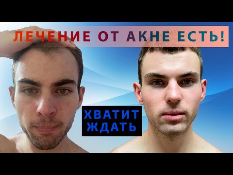 Видео: Как я победил акне?