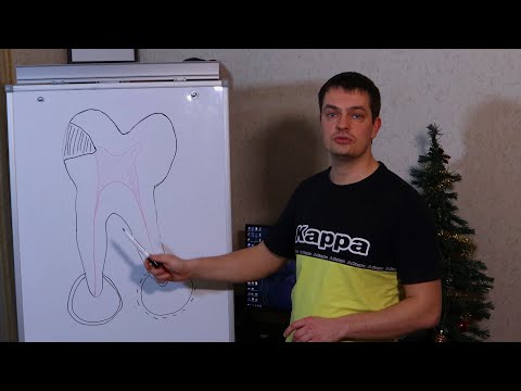 Видео: Периодонтит - киста и гранулема зуба - отличия, причины и этапы формирования - прогнозы лечения