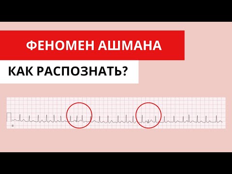Видео: Феномен Ашмана. Что это такое? Как выглядит на ЭКГ?