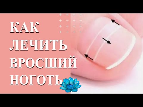 Видео: Вросший ноготь лечение коррекционной системой.