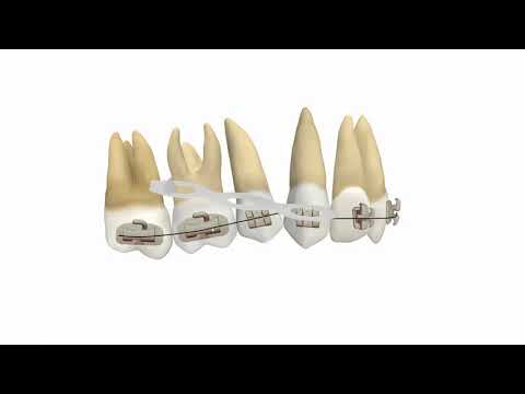 Видео: Эффект лука в ортодонтии