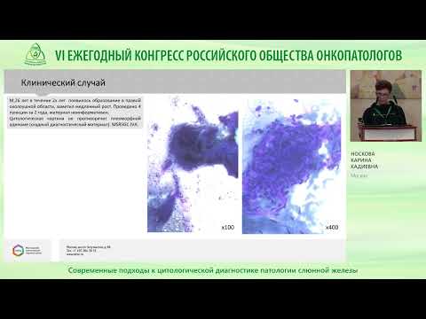 Видео: Современные подходы к цитологической диагностике патологии слюнной железы