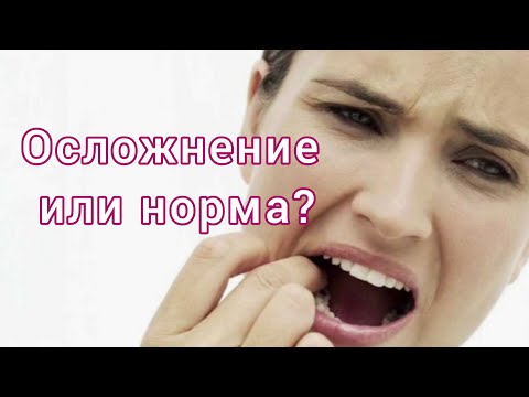 Видео: Осложнения после ИМПЛАНТАЦИИ зубов. ОТЕК после имплантации зубов. ОТТОРЖЕНИЕ импланта.