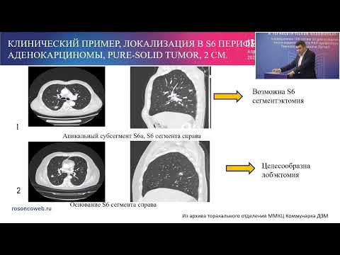 Видео: Торакоскопическая хирургия при локализованных формах периферического рака легкого