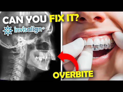 Видео: Может ли Invisalign исправить неправильный прикус?... Объясняет ортодонт