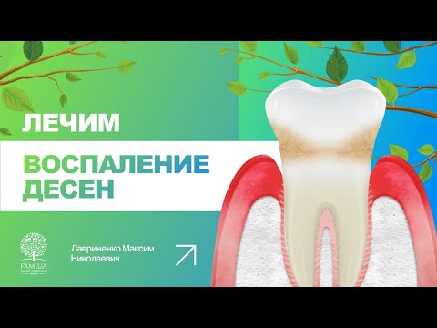 Видео: 👨‍⚕️ Как лечить воспаление десен?