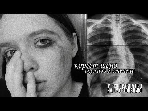 Видео: СКОЛИОЗ 3 СТЕПЕНИ  И КОРСЕТ ШЕНО. ВСЯ ПРАВДА. МОЯ НАСТОЯЩАЯ ИСТОРИЯ.