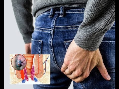 Видео: ГЕМОРРОЙ учун табылгыс дары ...........