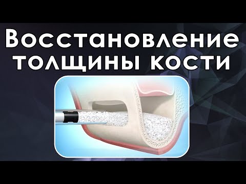 Видео: Латеральный синус-лифтинг по технике Томазо Верчелотти