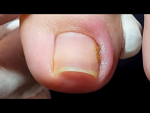 Видео: 😳БЕДНАЯ ДЕВОЧКА! ВРОСШИЙ НОГОТЬ НА ОБОИХ ПАЛЬЦАХ НОГ (с субтитрами)