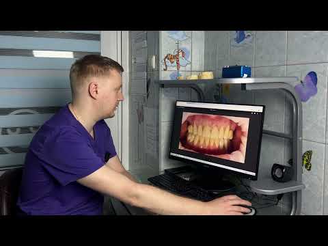 Видео: Протезирование зубов. Кейсы пациентов