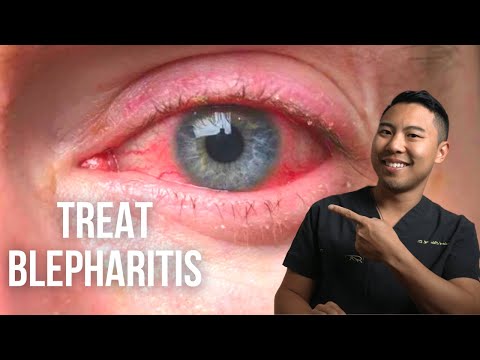 Видео: Как лечить блефарит (3 научно обоснованных способа) | Офтальмолог @MichaelRChuaMD