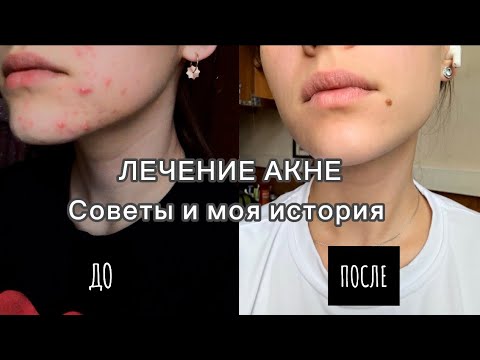 Видео: Как избавиться от акне: мой путь к чистой коже | Лечение акне | Уход за кожей