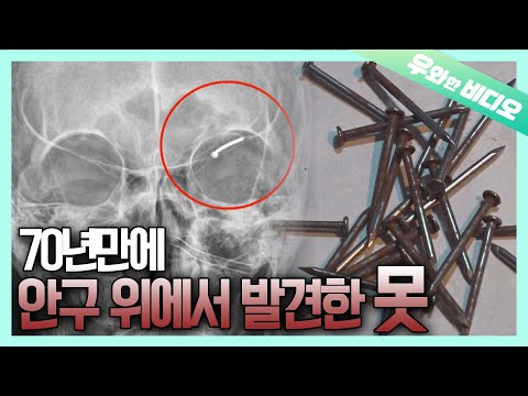 Видео: Нашел ГВОЗДЬ в голове ...!