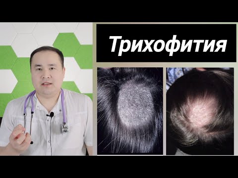 Видео: СОЧ ТЕРИСИ ЗАМБУРУҒ ТРИХОФИТИЯ КАСАЛЛИГИ ҲАҚИДА БАФУРЖА МАЪЛУМОТ ДОКТОР ИСЧАНОВ