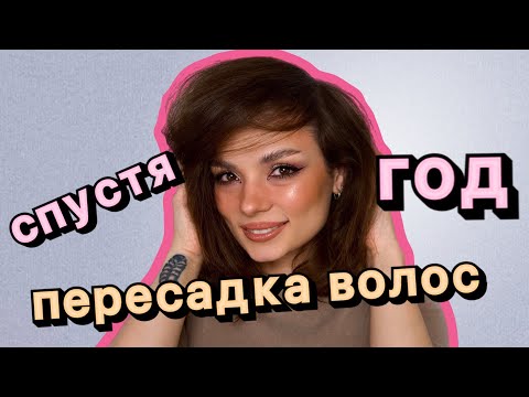 Видео: Пересадка волос, год спустя. #ugolekmakeup  #пересадкаволос #пересадкаволосгодспустя