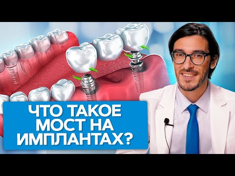 Видео: Что такое мост на имплантах? Что такое мост на имплантах и как сэкономить на имплантации зубов?