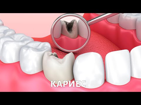 Видео: Что такое КАРИЕС?