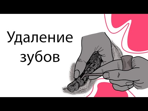 Видео: Удаление зубов