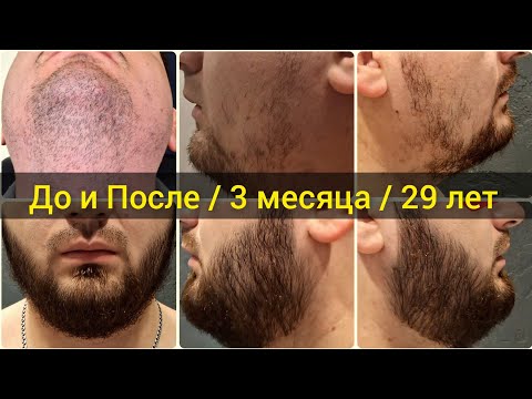 Видео: Борода за 3 месяца в 29 лет. Выпуск 71 Андрей Борода