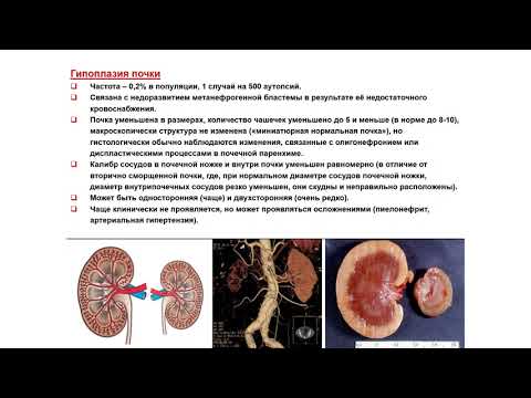 Видео: УЗИ. Доктор Иогансен. Выпуск 70. Аномалии развития почек и мочеточников. Часть 2.