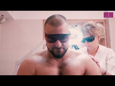 Видео: Лазерная эпиляция для мужчин