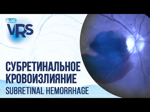 Видео: Субретинальное кровоизлияние. Лечение | Subretinal hemorrhage. Treatment