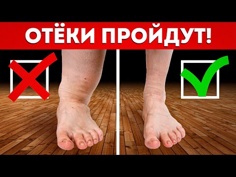 Видео: НОГИ больше не будут ОТЕКАТЬ! / ЭФФЕКТИВНОЕ лечение отеков ног