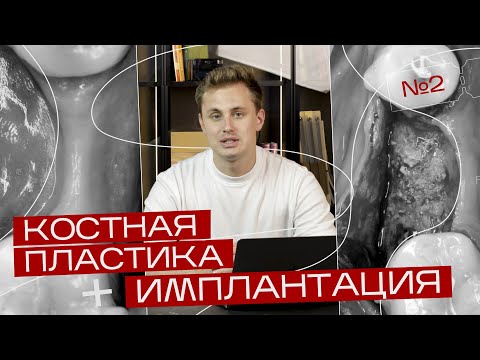 Видео: Установка имплантата с направленной костной регенерацией. Sausage Technique. Игорь Налиткин.