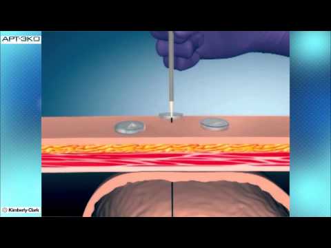 Видео: Рекомендуемая процедура установки гастростомической трубки MIC-Key