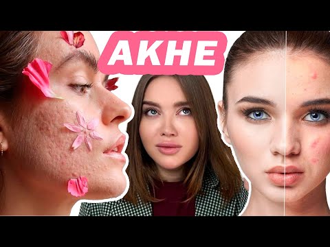 Видео: АКНЕ изучение проблемы! (Лекция 3-4 из марафона по лечению АКНЕ)