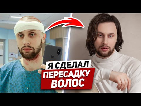 Видео: ПРОВЕРИЛ НА СЕБЕ ПЕРЕСАДКУ ВОЛОС