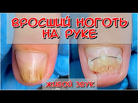 Видео: Вросший ноготь / Скрученный ноготь / Титановая нить установка /  Грибок на ногтях