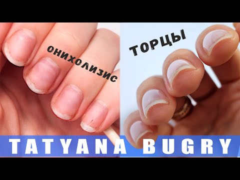 Видео: НУЖНО ЗАПЕЧАТЫВАТЬ ТОРЦЫ ❓ У МЕНЯ БЫЛ ОНИХОЛИЗИС ❓/ Татьяна Бугрий