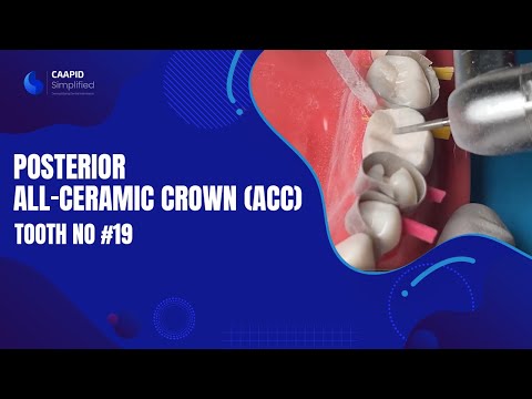 Видео: Цельнокерамическая коронка для жевательных зубов (ACC) на зуб № 19 | Полный курс по ссылке ниже