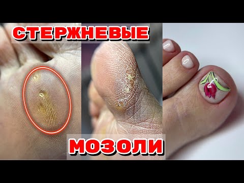 Видео: Как удалить СТЕРЖНЕВЫЕ МОЗОЛИ 🦶 Педикюр 🦶Подногтевая мозоль🦶Обработка стоп дисками