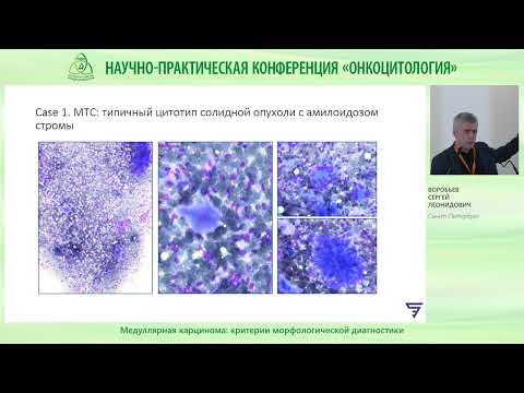 Видео: Медуллярная карцинома щитовидной железы – критерии морфологической диагностики