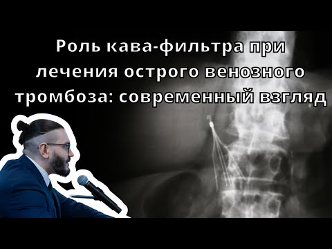 Видео: Видеолекция "Роль кава-фильтра при лечения острого венозного тромбоза: современный взгляд"