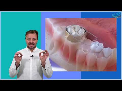 Видео: МЕСТОПАЗИТЕЛИ при загуба на зъб, #ортодонтия #ортодонт #брекети