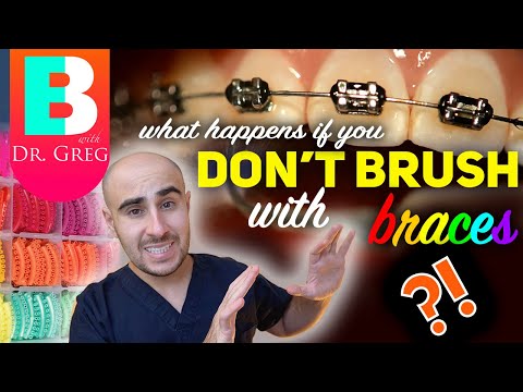 Видео: Чистка зубов с брекетами!