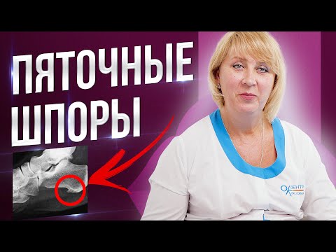 Видео: Пяточная шпора. Симптомы, причины, диагностика, лечение.