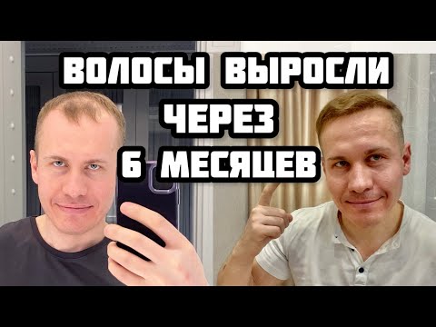 Видео: ПЕРЕСАДКА ВОЛОС 6 месяцев. Результаты моей пересадки волос
