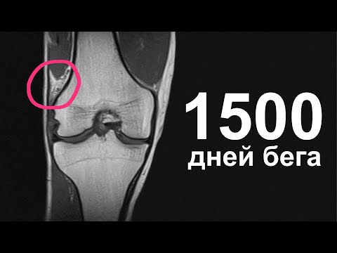 Видео: Что с коленом после 4 лет ежедневного бега?