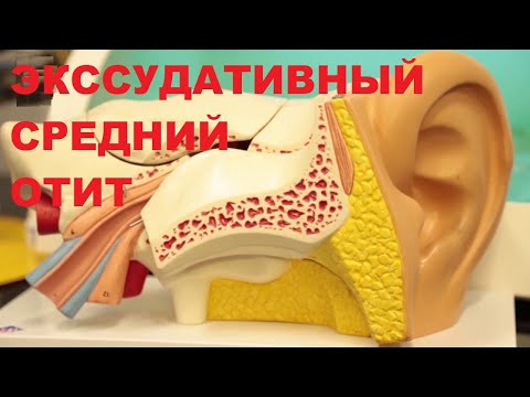 Видео: Экссудативный средний отит. Шунтирование барабанной полости.