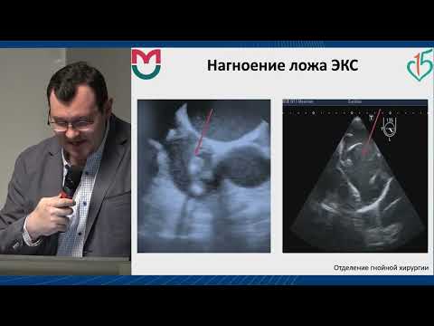 Видео: Инфекционный эндокардит в многопрофильном стационаре. Дорошенко Д.А.